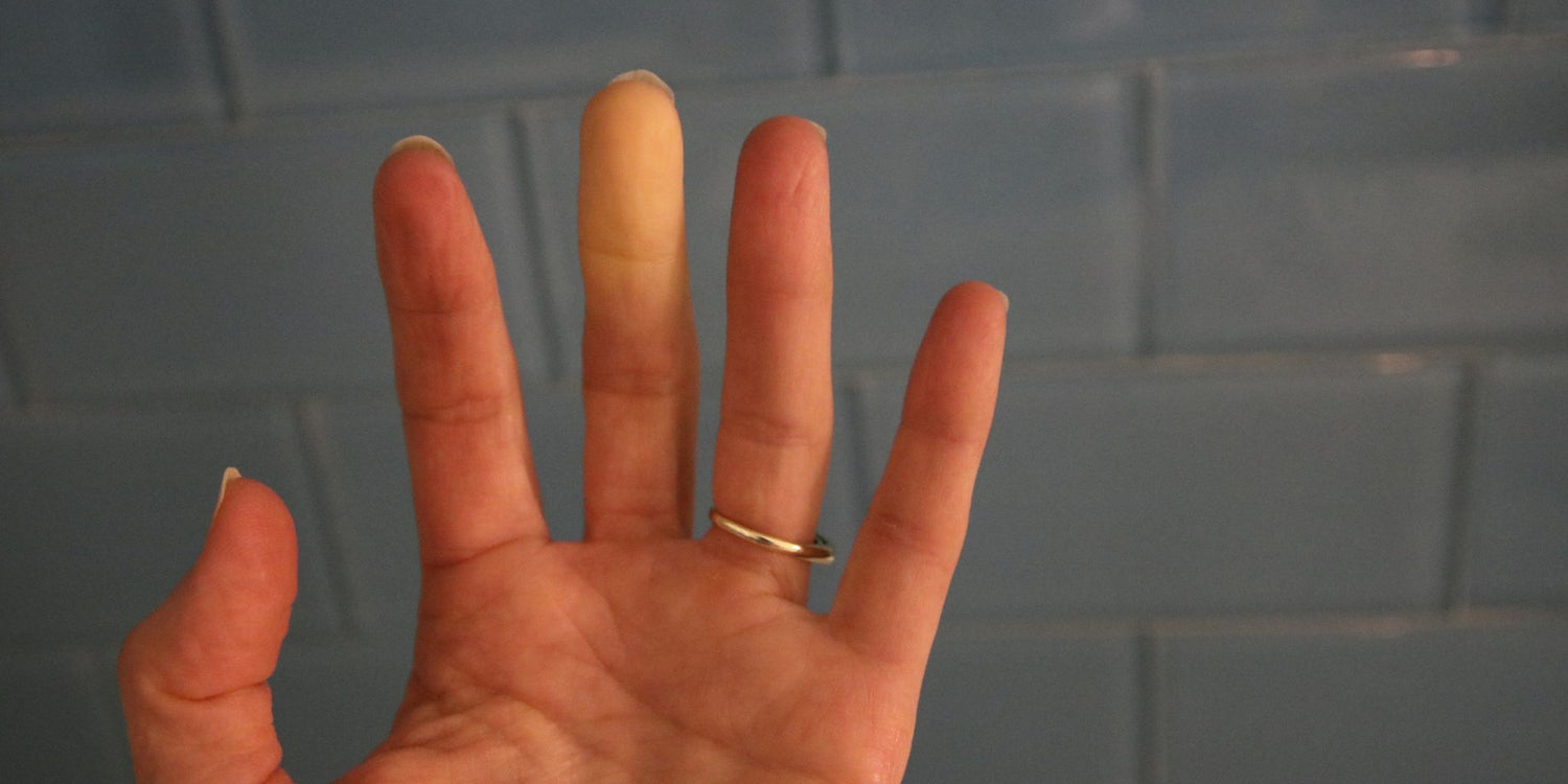 Auswirkungen Raynaud Syndrom